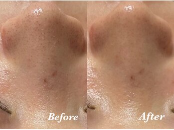 マシェ バイ マユ(Mache by Mayu)/黒ずみすっきり！