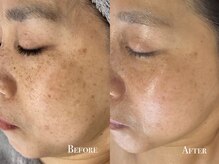 イースト(EAST)/プラズマ10回→シミケア2回