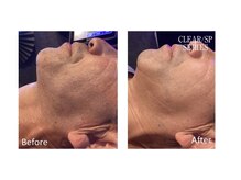 ニコ(nico)/青ヒゲは老けて見えがち、、