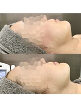 カンナムビューティー/オンダリフト/表参道/ララピール