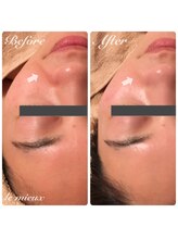 ル ミュー(le mieux)/REVI陶肌トリートメント