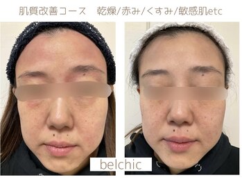 ベルシック(Belchic)/【本気の肌質改善コース】