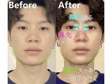 ラプリ 浜松店(Raplit)/ 隆鼻＋輪郭矯正40分10回