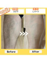 クオレ(CUORE)/脱毛