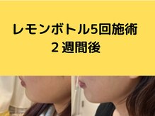 フェリス(feliz)/レモンボトル[小顔/美白/白石区]