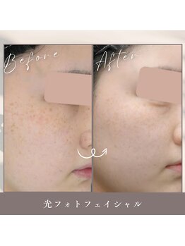 ティエルプラス(tiele+)/光フェイシャル5回