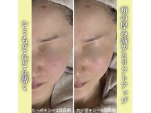 ハニエル(Haniel)/カーボキシー症例