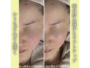 ハニエル(Haniel)/カーボキシー症例