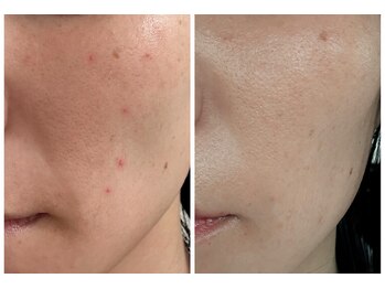 ヨサパーク プラム(YOSA PARK Plum)の写真/【今話題の水素吸入取り扱いサロン】天然ハーブミストで最高の美肌を手に入れる♪乾燥ケアもお任せ◎