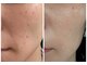 ヨサパーク プラム(YOSA PARK Plum)の写真/【今話題の水素吸入取り扱いサロン】天然ハーブミストで最高の美肌を手に入れる♪乾燥ケアもお任せ◎