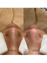 毛穴専科/毛穴洗浄で毛穴美人に