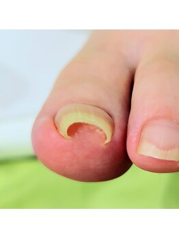 ニコルル 高崎パルクハナミズキ店(Nicolulu)/巻き爪ビフォー