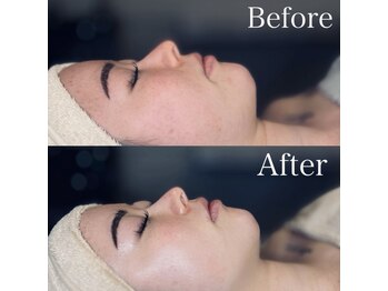 エクリア(ECLIA)/フェイシャル Before⇒After