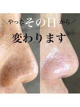 アーフ(ARF)/肌質改善