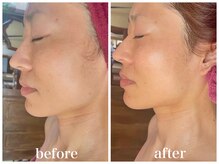 ルー ハナレ 神戸岡本 摂津本山店(Luu HANARE)/月1 【肌リストアコース】