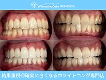 ホワイトニングカフェ 博多駅前店(WhiteningCafe)