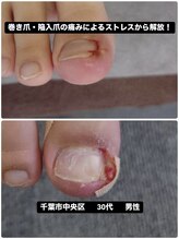 巻き爪じゅん 船橋店/巻き爪・陥入爪による痛みが改善