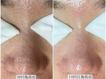 シエール 調布(Ci'aile)/毛穴集中ケア