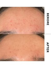 ゼロ(ZERO)/ダクトピール