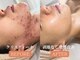 ヴィクトリアサロン(VICTORIA SALON)の写真/【本気の肌質改善】種類豊富な“肌質改善メニュー”で気になる肌悩みにアプローチ◎お肌を見違えらせます★