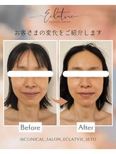 エクラヴィ(Eclatvie)/３０代★施術事例