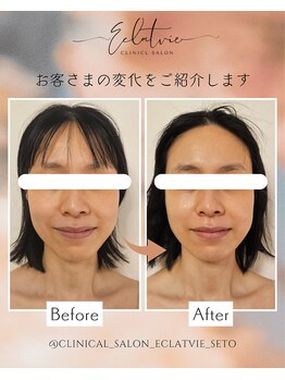 エクラヴィ(Eclatvie)/30代★施術事例