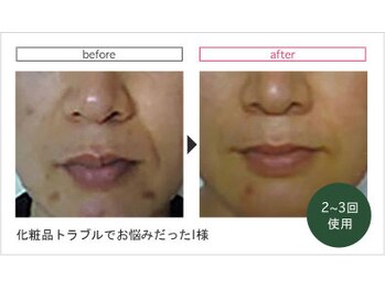 ピアーノ(PIANO)/OHL天然ハーブピーリング