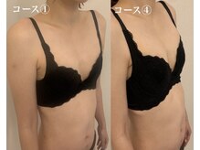 ギフト 浦和(GIFT)/バストアップ症例