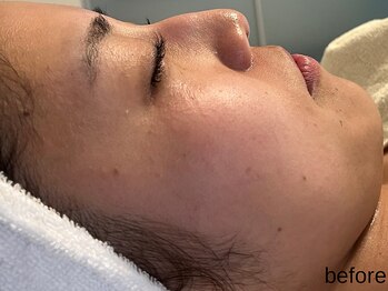 サロン ド エメ(salon de aimer)/【Before】開き毛穴やくすみに