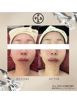 アドラーブル プレ葉ウォーク浜北店/プラピール　女性症例写真 2