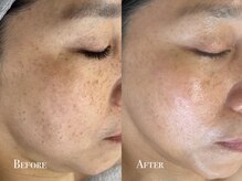 イースト(EAST)/プラズマ10回→シミケア2回