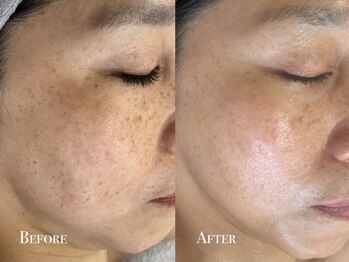 イースト(EAST)/プラズマ10回→シミケア2回