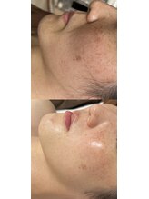 ヨルエステ(yoru aesthe)/【シミ・シミ予防ケア】