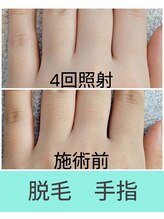 エミナル(EMINAL)/手指脱毛の効果！ 脱毛/毛穴