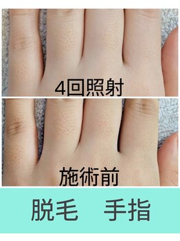 エミナル(EMINAL)/手指脱毛の効果! 脱毛/毛穴