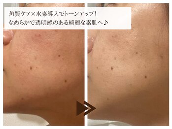 レイテノール 藤沢店の写真/【ハリツヤ肌×本格ケア】角質ケア×高濃度水素で透明感溢れる美肌づくり☆シミ・くすみ改善はお任せ！