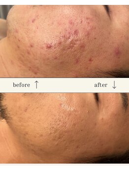 リメレ(Rimere)/ニキビケア