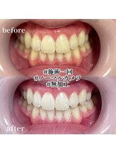 エピリス(Epiliss)/ホワイトニングビフォーアフター