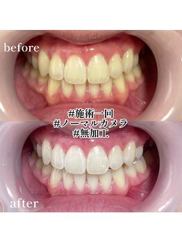 エピリス(Epiliss)/ホワイトニングビフォーアフター