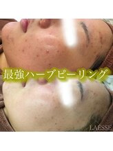 ラエッセ(LAESSE)/最強ハーブピーリング♪