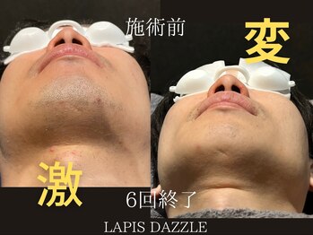 ラピスダズル(LAPIS DAZZLE)/ひげ脱毛☆途中経過