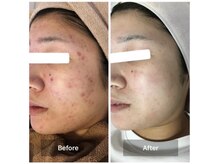 モカ 天王寺店(MOKA)/ホホニキビケア　ピーリング