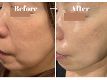 カラーリリー アンド ユン(Calla lily & yun)/気になるたるみにヒト幹細胞ケア