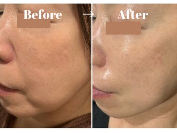 カラーリリー アンド ユン(Calla lily & yun)/気になるたるみにヒト幹細胞ケア