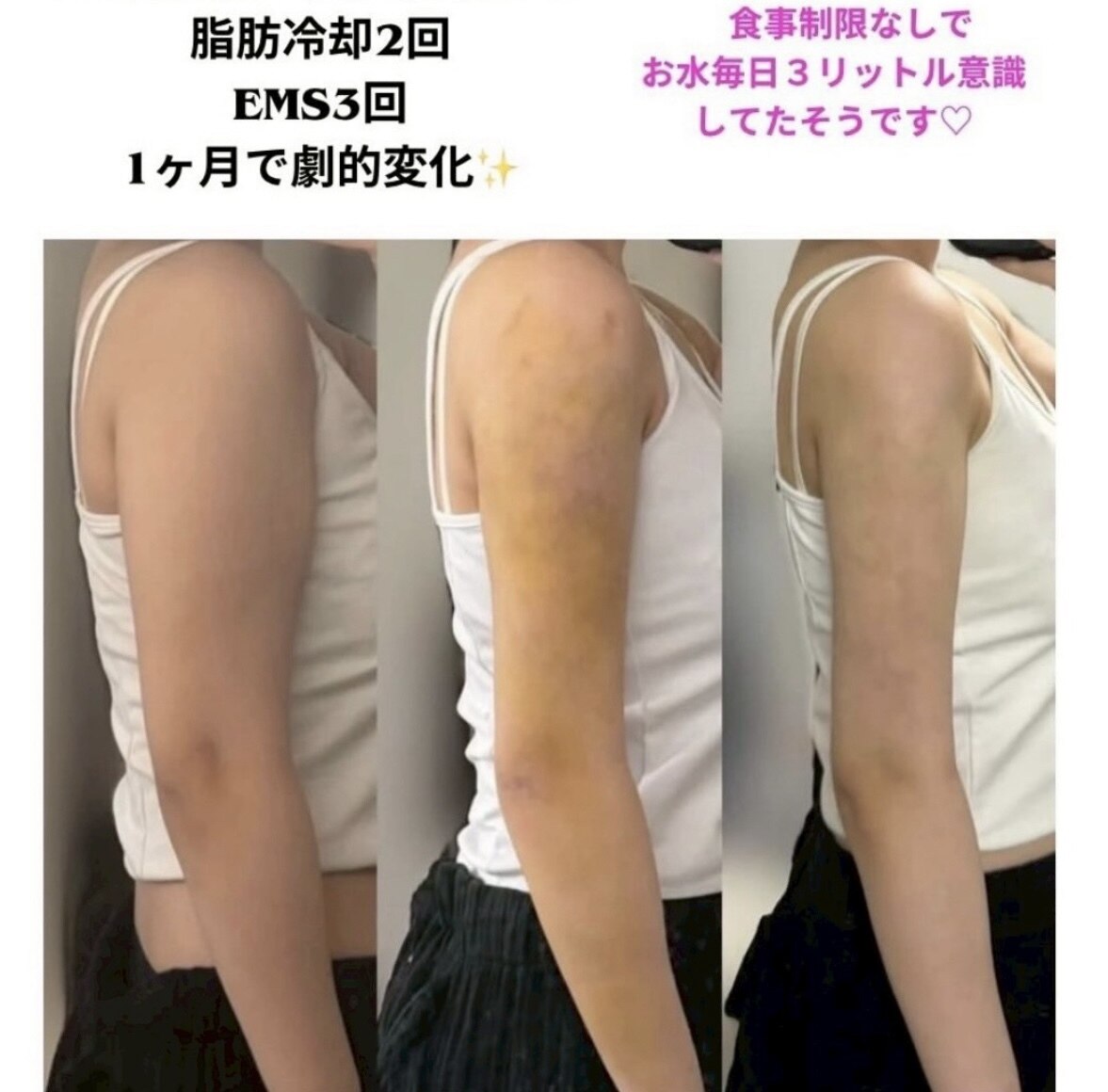【新品未使用】リリーホットスリマー　波動形空気圧美容器 ダイエット　細脚　浮腫 波動形空気圧美容器 リリーホットスリマー