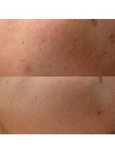 サロンナナジュウニ(Salon72)/ニキビ