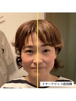 甲陽園鍼灸わたぐも/クリップアップ着用変化