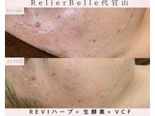 ルリエベル(Relier Belle)/REVIハーブピーリング