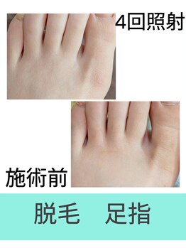 エミナル(EMINAL)/足指脱毛の効果! 脱毛/毛穴