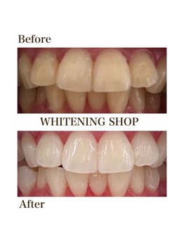ホワイトニングショップ 徳島藍住店/Before After美白ホワイトニング